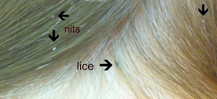 orlando head lice treatment center