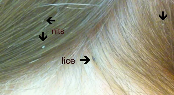 Lice and nits in hair.