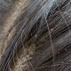 How to Know If You Have Lice or Dandruff